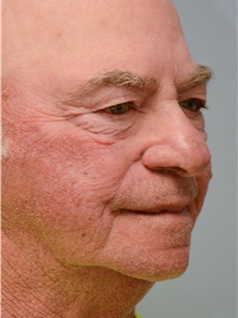 Head and Neck Skin Cancer Reconstruction After Photo by Carlos Rivera-Serrano, MD; Bay Harbour Islands, FL - Case 44411