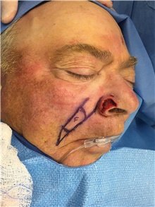 Head and Neck Skin Cancer Reconstruction Before Photo by Carlos Rivera-Serrano, MD; Bay Harbour Islands, FL - Case 44411