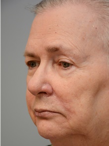 Head and Neck Skin Cancer Reconstruction After Photo by Carlos Rivera-Serrano, MD; Bay Harbour Islands, FL - Case 44412