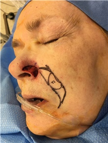 Head and Neck Skin Cancer Reconstruction Before Photo by Carlos Rivera-Serrano, MD; Bay Harbour Islands, FL - Case 44412