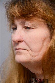 Head and Neck Skin Cancer Reconstruction After Photo by Carlos Rivera-Serrano, MD; Bay Harbour Islands, FL - Case 44413