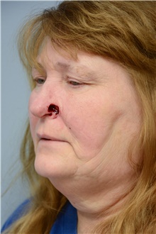 Head and Neck Skin Cancer Reconstruction Before Photo by Carlos Rivera-Serrano, MD; Bay Harbour Islands, FL - Case 44413