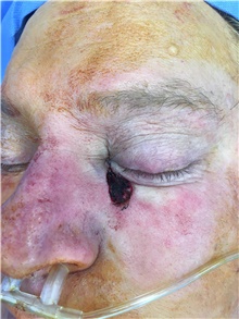 Head and Neck Skin Cancer Reconstruction Before Photo by Carlos Rivera-Serrano, MD; Bay Harbour Islands, FL - Case 44414