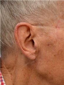 Head and Neck Skin Cancer Reconstruction After Photo by Carlos Rivera-Serrano, MD; Bay Harbour Islands, FL - Case 44415