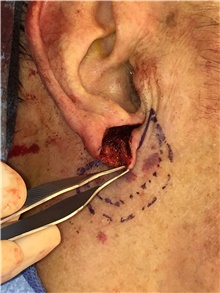 Head and Neck Skin Cancer Reconstruction Before Photo by Carlos Rivera-Serrano, MD; Bay Harbour Islands, FL - Case 44415