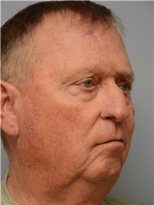 Head and Neck Skin Cancer Reconstruction After Photo by Carlos Rivera-Serrano, MD; Bay Harbour Islands, FL - Case 44419