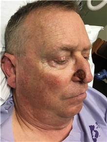 Head and Neck Skin Cancer Reconstruction Before Photo by Carlos Rivera-Serrano, MD; Bay Harbour Islands, FL - Case 44419