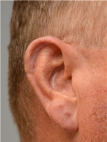 Head and Neck Skin Cancer Reconstruction After Photo by Carlos Rivera-Serrano, MD; Bay Harbour Islands, FL - Case 44420