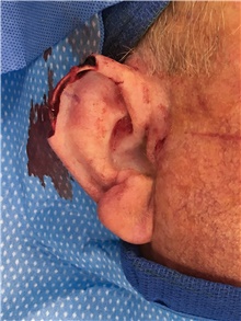 Head and Neck Skin Cancer Reconstruction Before Photo by Carlos Rivera-Serrano, MD; Bay Harbour Islands, FL - Case 44420
