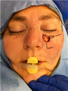 Head and Neck Skin Cancer Reconstruction Before Photo by Carlos Rivera-Serrano, MD; Bay Harbour Islands, FL - Case 44421
