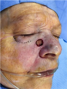 Head and Neck Skin Cancer Reconstruction Before Photo by Carlos Rivera-Serrano, MD; Bay Harbour Islands, FL - Case 44422