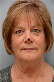 Head and Neck Skin Cancer Reconstruction Before Photo by Carlos Rivera-Serrano, MD; Bay Harbour Islands, FL - Case 44423