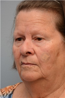 Head and Neck Skin Cancer Reconstruction After Photo by Carlos Rivera-Serrano, MD; Bay Harbour Islands, FL - Case 44424