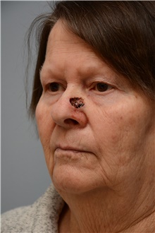 Head and Neck Skin Cancer Reconstruction Before Photo by Carlos Rivera-Serrano, MD; Bay Harbour Islands, FL - Case 44424
