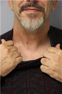Head and Neck Skin Cancer Reconstruction After Photo by Carlos Rivera-Serrano, MD; Bay Harbour Islands, FL - Case 44425