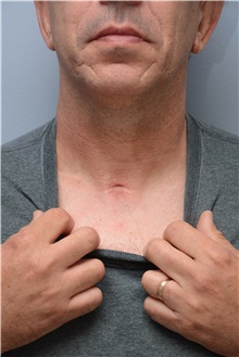 Head and Neck Skin Cancer Reconstruction Before Photo by Carlos Rivera-Serrano, MD; Bay Harbour Islands, FL - Case 44425