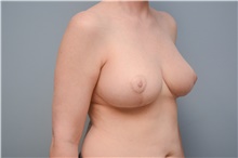 Breast Reconstruction After Photo by Carlos Rivera-Serrano, MD; Bay Harbour Islands, FL - Case 44585