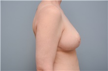 Breast Reconstruction After Photo by Carlos Rivera-Serrano, MD; Bay Harbour Islands, FL - Case 44585