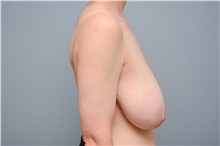 Breast Reconstruction Before Photo by Carlos Rivera-Serrano, MD; Bay Harbour Islands, FL - Case 44585