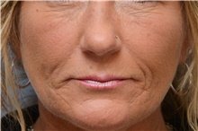 Injectable Fillers After Photo by Carlos Rivera-Serrano, MD; Bay Harbour Islands, FL - Case 44587