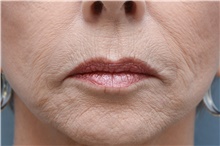 Injectable Fillers After Photo by Carlos Rivera-Serrano, MD; Bay Harbour Islands, FL - Case 44588