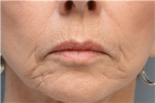Injectable Fillers Before Photo by Carlos Rivera-Serrano, MD; Bay Harbour Islands, FL - Case 44588