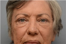 Eyelid Ptosis Repair After Photo by Carlos Rivera-Serrano, MD; Bay Harbour Islands, FL - Case 44589