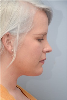 Neck Lift After Photo by Carlos Rivera-Serrano, MD; Bay Harbour Islands, FL - Case 44591