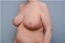 Breast Reconstruction After Photo by Carlos Rivera-Serrano, MD; Bay Harbour Islands, FL - Case 44592
