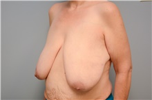 Breast Reconstruction Before Photo by Carlos Rivera-Serrano, MD; Bay Harbour Islands, FL - Case 44592