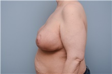 Breast Reconstruction After Photo by Carlos Rivera-Serrano, MD; Bay Harbour Islands, FL - Case 44592