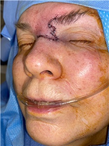 Skin Cancer Removal After Photo by Carlos Rivera-Serrano, MD; Bay Harbour Islands, FL - Case 44594