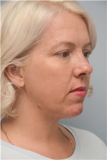 Neck Lift After Photo by Carlos Rivera-Serrano, MD; Bay Harbour Islands, FL - Case 44596