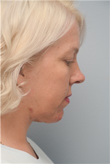 Neck Lift After Photo by Carlos Rivera-Serrano, MD; Bay Harbour Islands, FL - Case 44596
