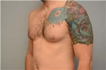 Male Breast Reduction Before Photo by Carlos Rivera-Serrano, MD; Bay Harbour Islands, FL - Case 44599