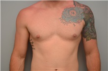 Male Breast Reduction After Photo by Carlos Rivera-Serrano, MD; Bay Harbour Islands, FL - Case 44599