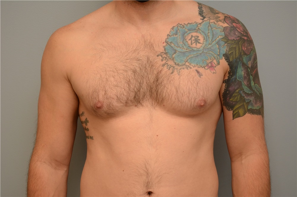 Could a Tattoo Affect Your Breast Augmentation Incision