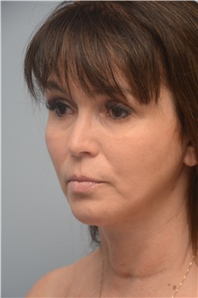 Neck Lift After Photo by Carlos Rivera-Serrano, MD; Bay Harbour Islands, FL - Case 44601