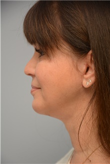 Neck Lift After Photo by Carlos Rivera-Serrano, MD; Bay Harbour Islands, FL - Case 44601