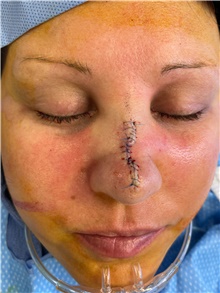Skin Cancer Removal Before Photo by Carlos Rivera-Serrano, MD; Bay Harbour Islands, FL - Case 44605