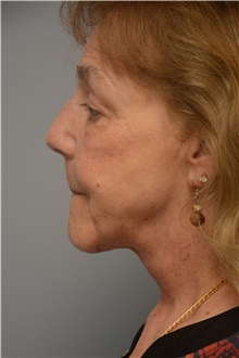 Neck Lift After Photo by Carlos Rivera-Serrano, MD; Bay Harbour Islands, FL - Case 44607