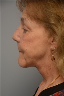 Neck Lift After Photo by Carlos Rivera-Serrano, MD; Miami Beach, FL - Case 44607