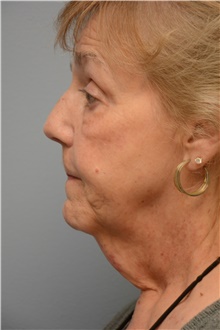 Neck Lift Before Photo by Carlos Rivera-Serrano, MD; Miami Beach, FL - Case 44607