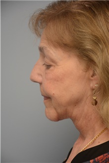Neck Lift After Photo by Carlos Rivera-Serrano, MD; Bay Harbour Islands, FL - Case 44607
