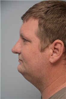 Rhinoplasty After Photo by Carlos Rivera-Serrano, MD; Miami Beach, FL - Case 44610