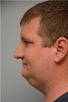 Rhinoplasty Before Photo by Carlos Rivera-Serrano, MD; Miami Beach, FL - Case 44610