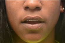 Lip Augmentation / Enhancement After Photo by Carlos Rivera-Serrano, MD; Carbondale, IL - Case 44612