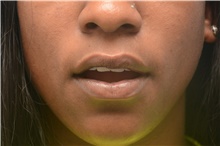 Lip Augmentation/Enhancement After Photo by Carlos Rivera-Serrano, MD; Bay Harbour Islands, FL - Case 44612