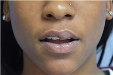 Lip Augmentation/Enhancement Before Photo by Carlos Rivera-Serrano, MD; Miami Beach, FL - Case 44612