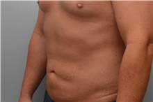 Liposuction After Photo by Carlos Rivera-Serrano, MD; Carbondale, IL - Case 44613
